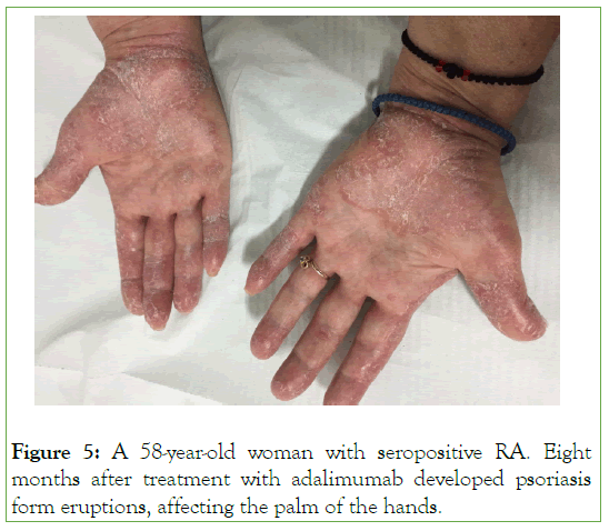 pharmacoepidemiology-drug-adalimumab