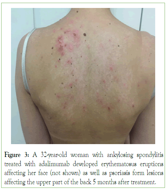 pharmacoepidemiology-drug-ankylosing