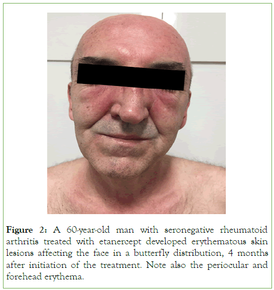 pharmacoepidemiology-drug-rheumatoid