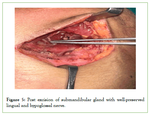 Vascular-Medicine-hypoglossal