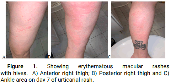 DMCR-macular