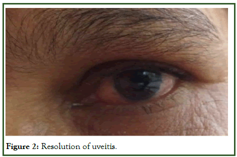 JP-uveitis