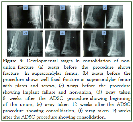 JSCRT-stages