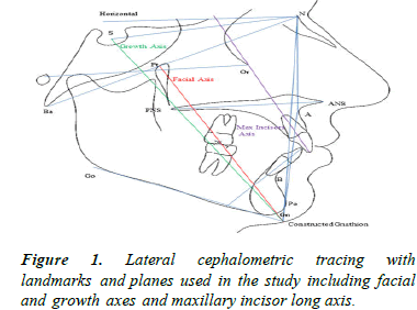 OHDM-Lateral