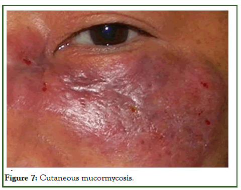 cmo-Cutaneous