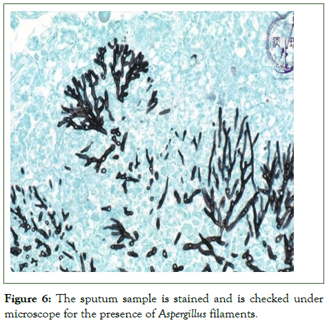 cmo-sputum