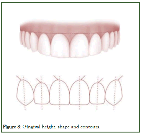 dcr-Gingival