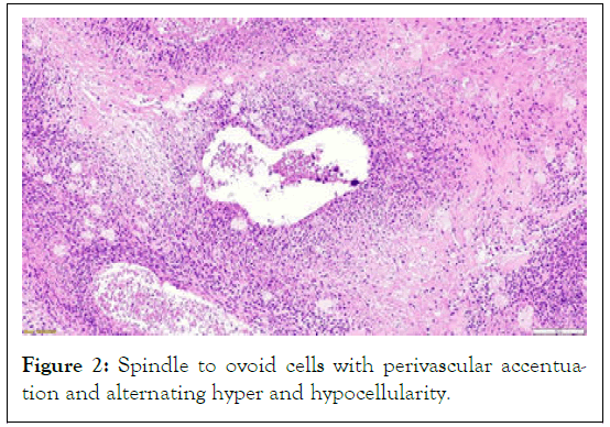 tumour-research-accentuation