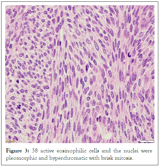 tumour-research-eosinophilic