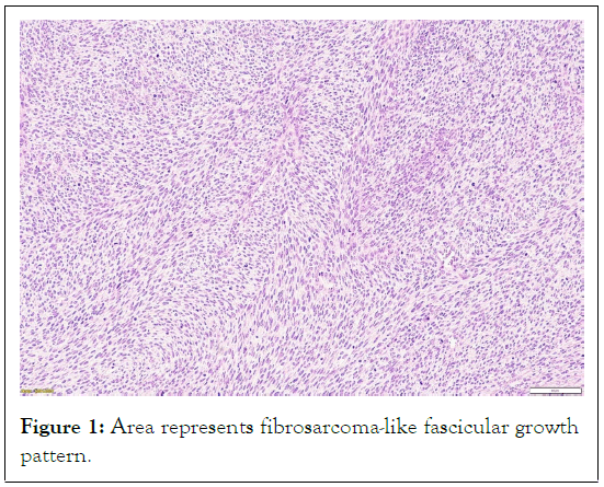 tumour-research-fibrosarcoma