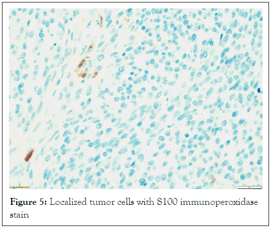 tumour-research-immunoperoxidase