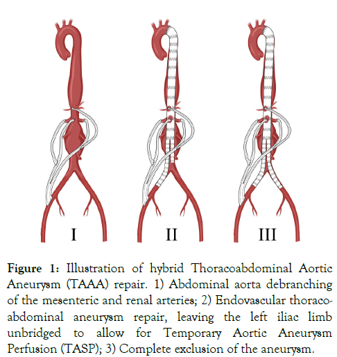 Thoracoabdominal