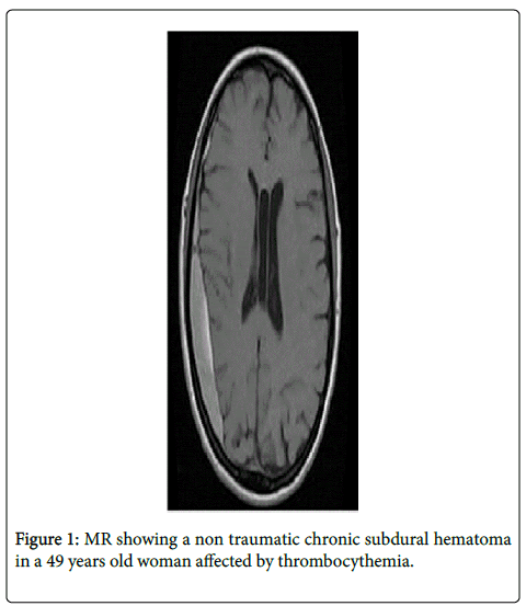 Hematologic Disturbances and Neurosurgery: Why Dont We Consider T