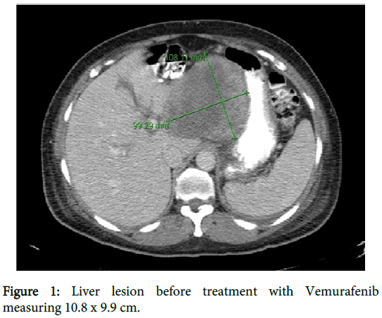 Neoadjuvant Vemurafenib for Borderline Resectable Metastatic Melanoma ...