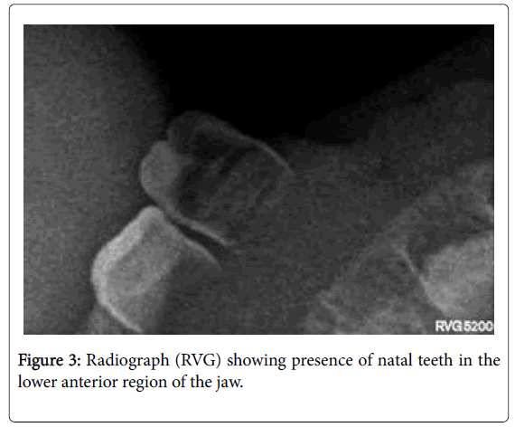 Natal Tooth An Overview And A Case Report 6186