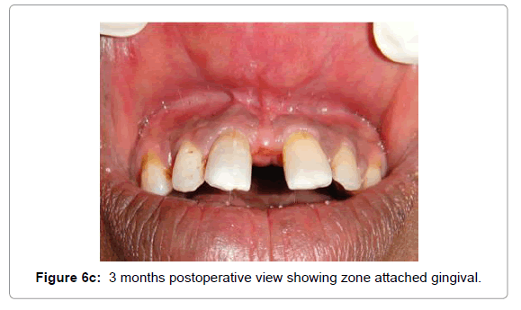 Comparative Results Of Frenectomy By Three Surgical Techniques ...