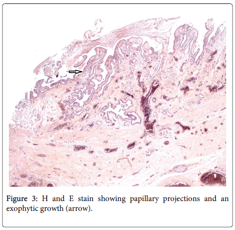 A Rare Cause of Biliary Obstruction