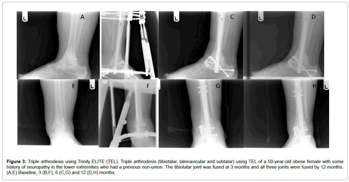 A Retrospective Clinical Comparison Of Two Allogeneic Bone Matrices