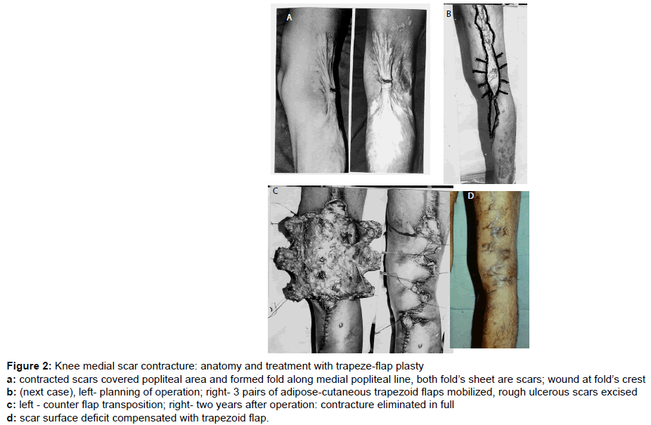 Postburn Knee Flexions Contractures: Anatomy And Methods Of Their