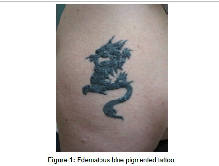 PDF) GRANULOMATOUS REACTION TO RED PIGMENT, AFTER PERMANENT DECORATIVE  TATTOO-CLINICAL CASE