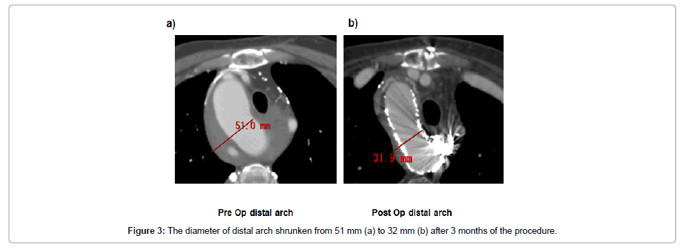 Staged Hybrid Repair For Acute Type B Aortic Dissection Of Right-